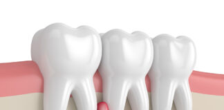 Эффективное лечение кистогранулемы: инновации в стоматологии