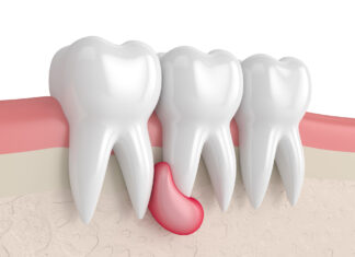Эффективное лечение кистогранулемы: инновации в стоматологии
